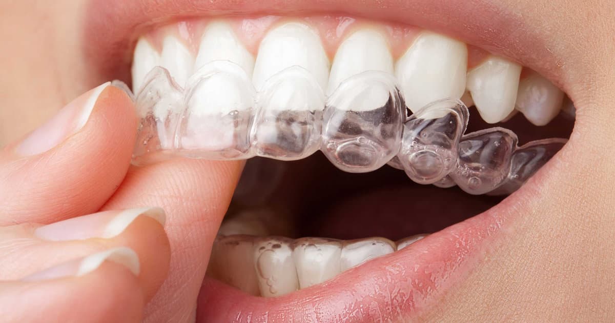 Get Ready for Invisalign Week, September 22 to 26!