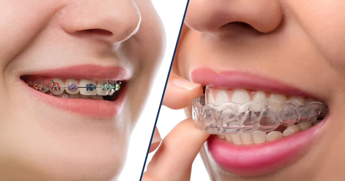 The Clear Choice: The Advantages of Invisalign Over Metal Braces